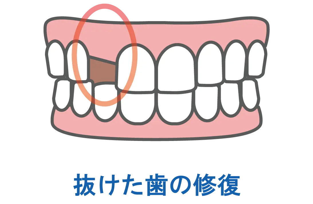 東京都港区青山の歯医者 ジルコニアに適している治療 : 抜けた歯の修復