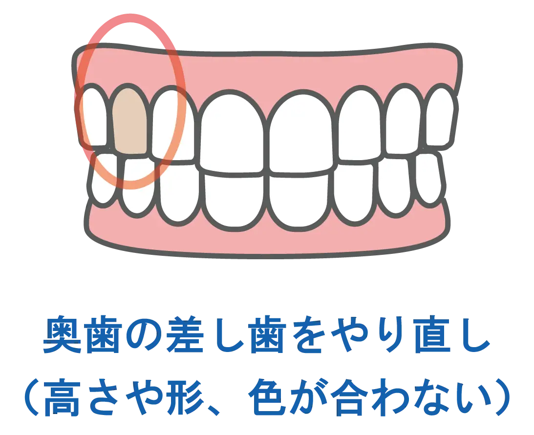 東京都港区青山の歯医者 ジルコニアに適している治療 : 差し歯のやり直し