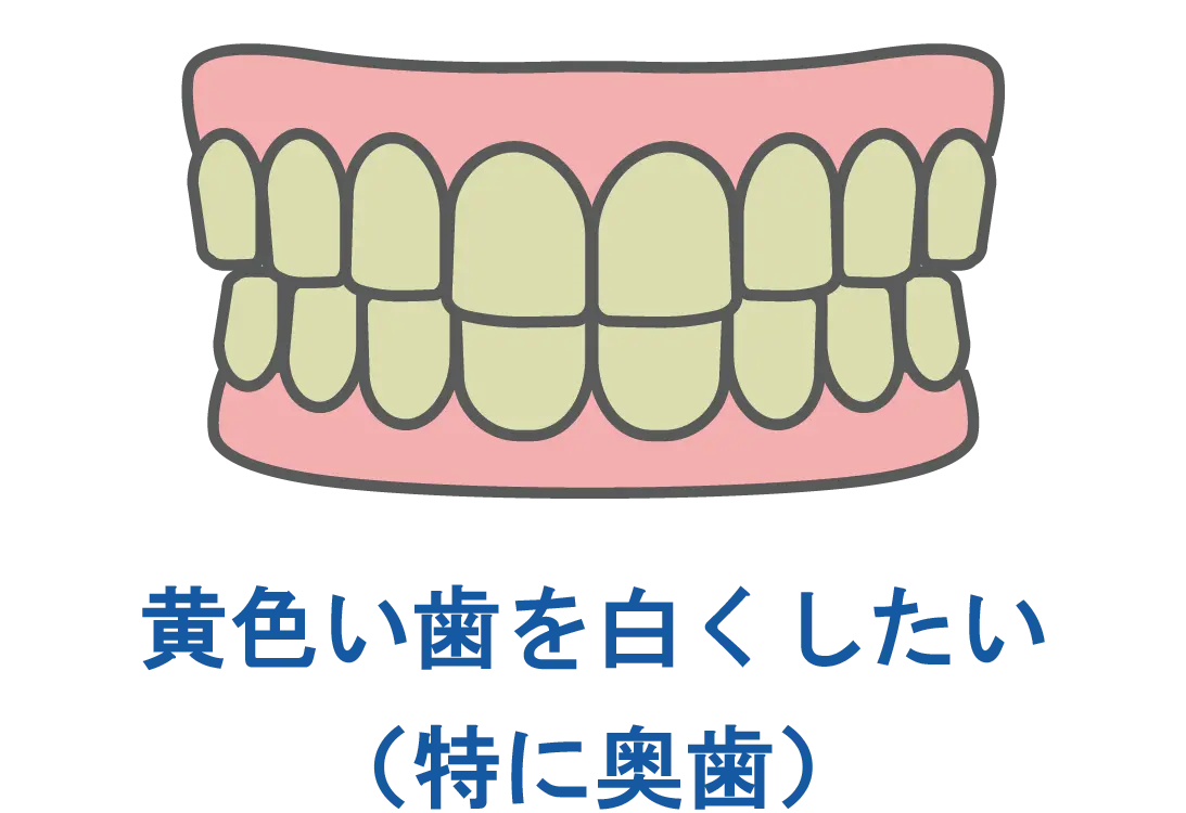 東京都港区青山の歯医者 ジルコニアに適している治療 : 歯の黄ばみ