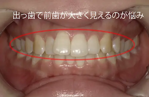 出っ歯の部分矯正 ビフォー｜東京・港区の歯医者