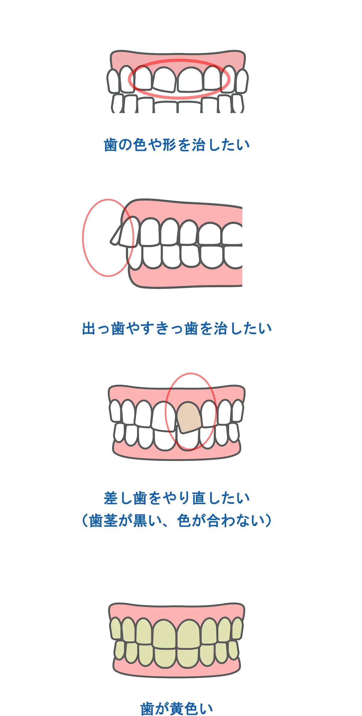 セラミック矯正に適している症例|東京・港区の歯医者
