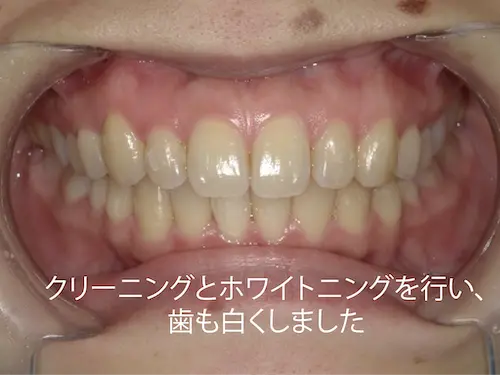 部分矯正 アフター｜東京・港区の歯医者