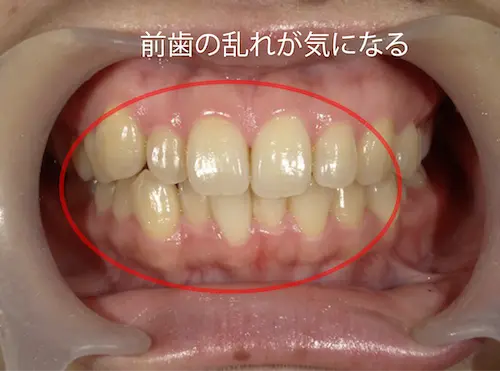 部分矯正 ビフォー｜東京・港区の歯医者