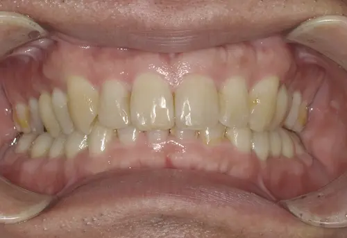 青山一丁目の歯医者による歯並びの矯正　マウスピース矯正の症例写真で変化を確認　アフター