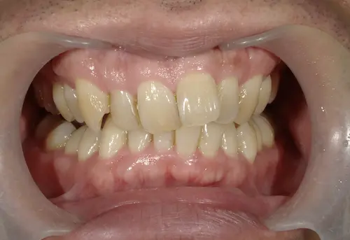 青山一丁目の歯医者による歯並びの矯正　マウスピース矯正の症例写真で変化を確認　ビフォー