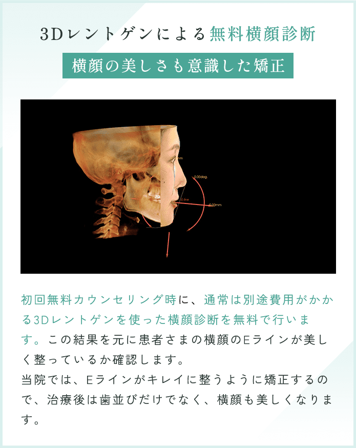 3Dレントゲンによる無料横顔診断　横顔の美しさも意識した矯正